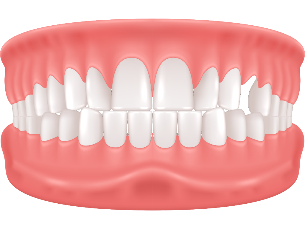 Fehlende Zähne